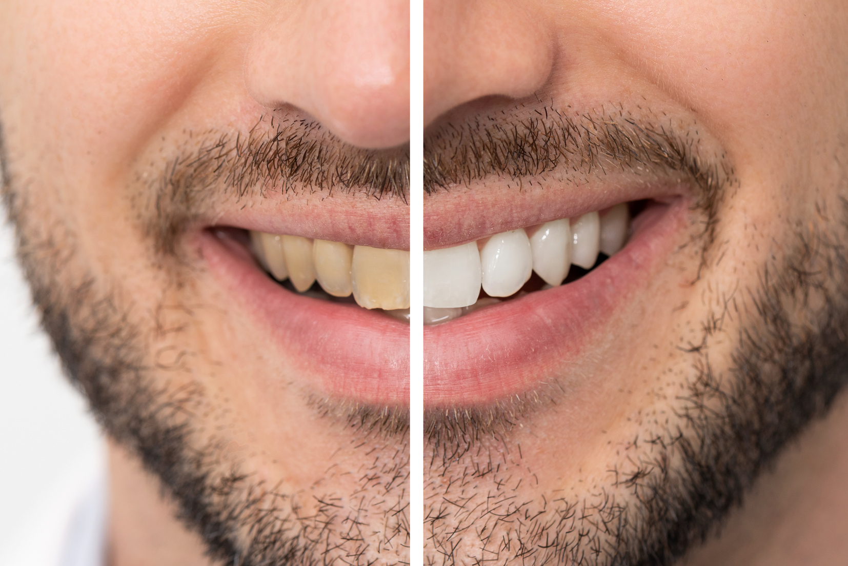 Teeth before and after whitening